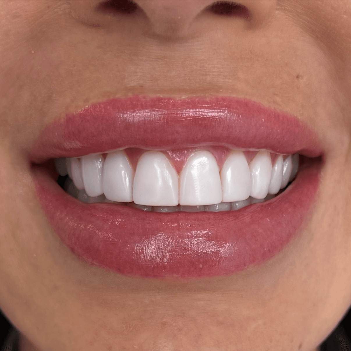 Veneers