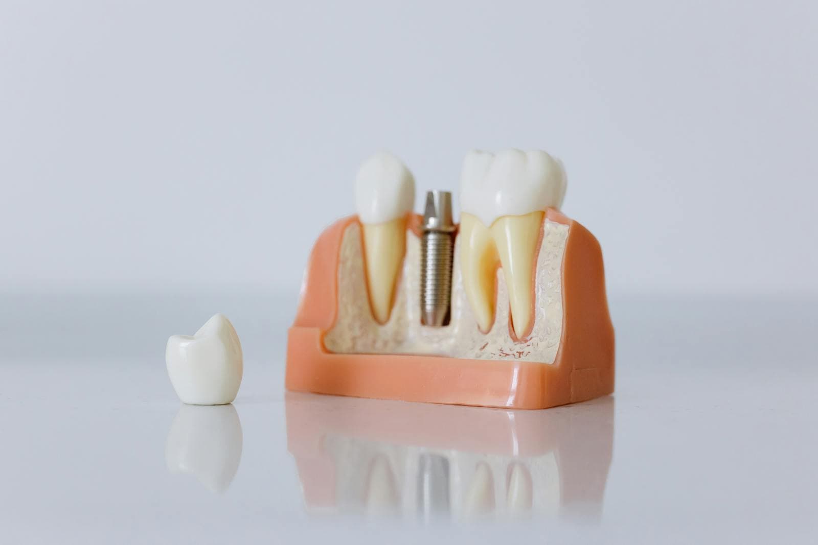 Close-up of a dental implant model with artificial teeth